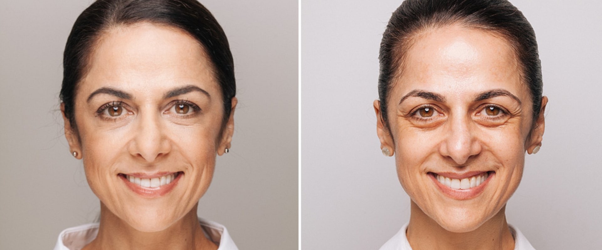 How Much Does Under Eye Filler UK Cost? A Comprehensive Guide