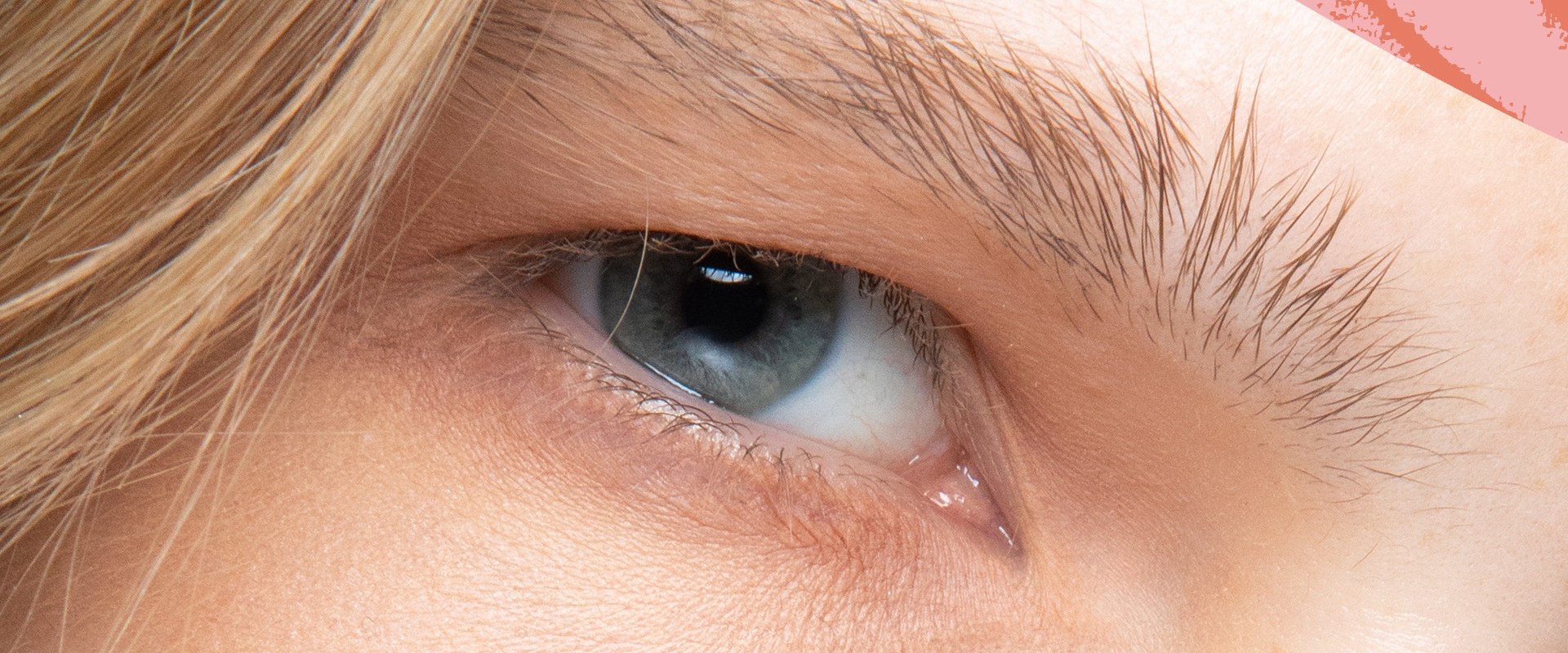 Does UnderEye Filler Make Wrinkles Worse?