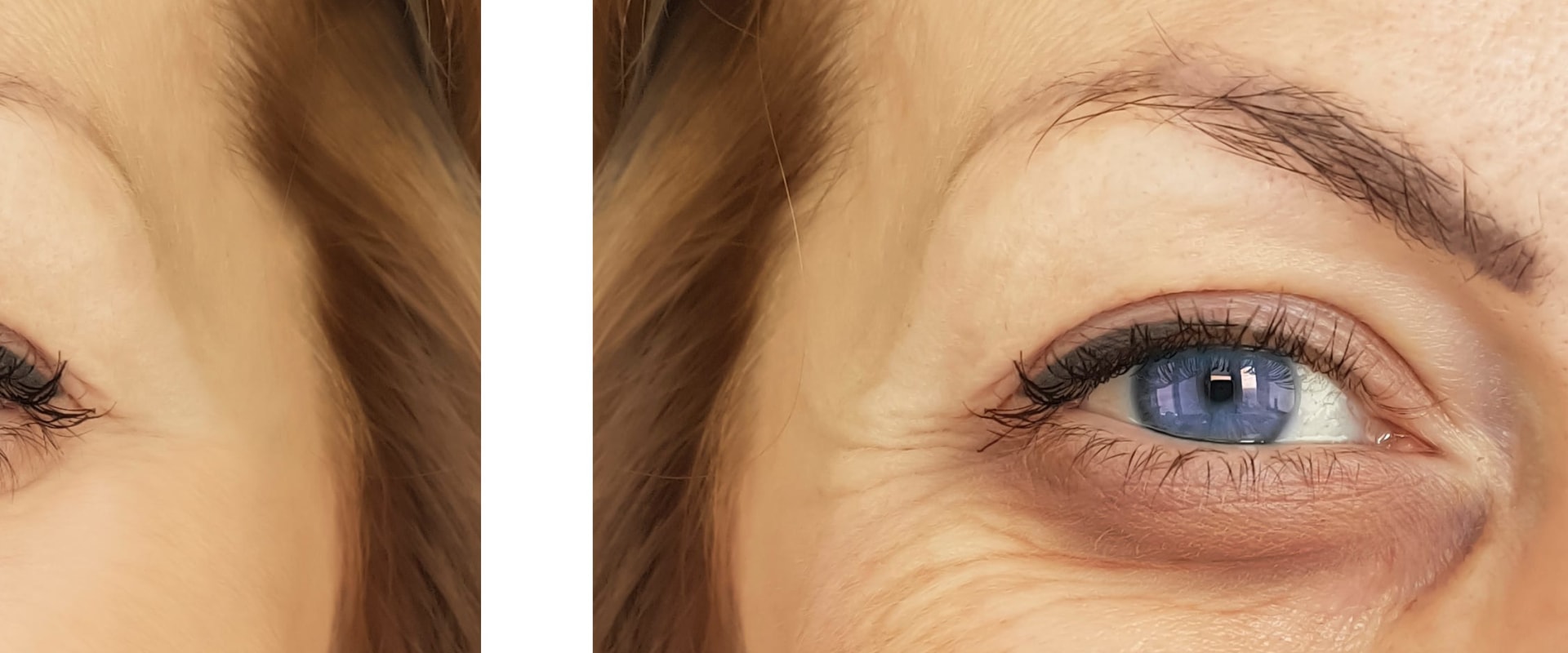 Are fillers for under the eyes safe