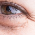 The Benefits of Under-Eye Fillers: Brighten Your Skin and Restore Volume