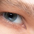 Does under-eye filler make wrinkles worse?