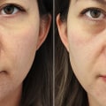 Are Under-Eye Fillers Worth It?