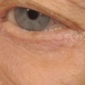 What Happens When Tear Filling Goes Wrong?