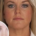 Do Fillers Cause Long-Term Damage?