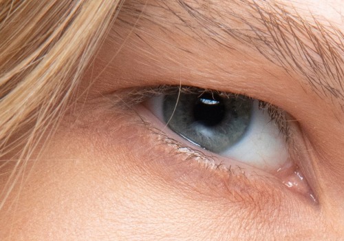 Can fillers make bags under the eyes worse?