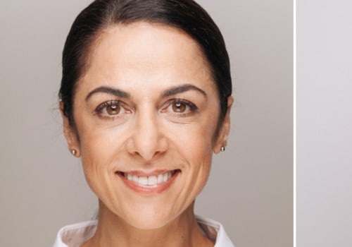 How Much Does Under Eye Filler UK Cost? A Comprehensive Guide
