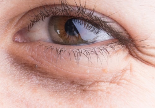 The Benefits of Under-Eye Fillers: Brighten Your Skin and Restore Volume