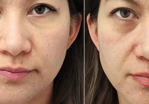 Are Under-Eye Fillers Worth It?