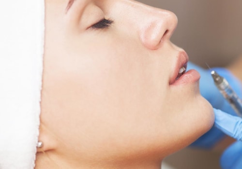 What Happens When Fillers Migrate?