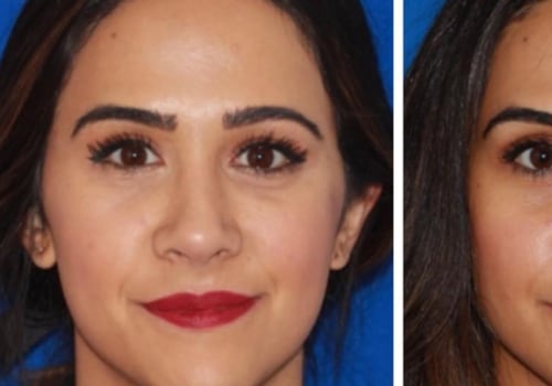 Can Fillers Move Under the Eyes? An Expert's Perspective