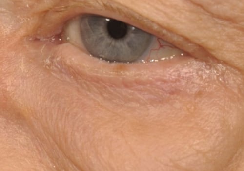 What Happens When Tear Filling Goes Wrong?