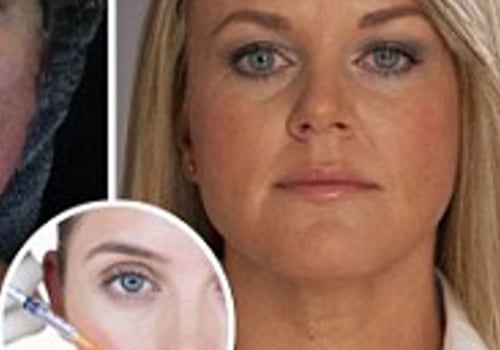Do Fillers Cause Long-Term Damage?