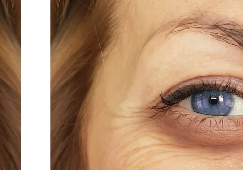 Will the filler under the eyes help with wrinkles?
